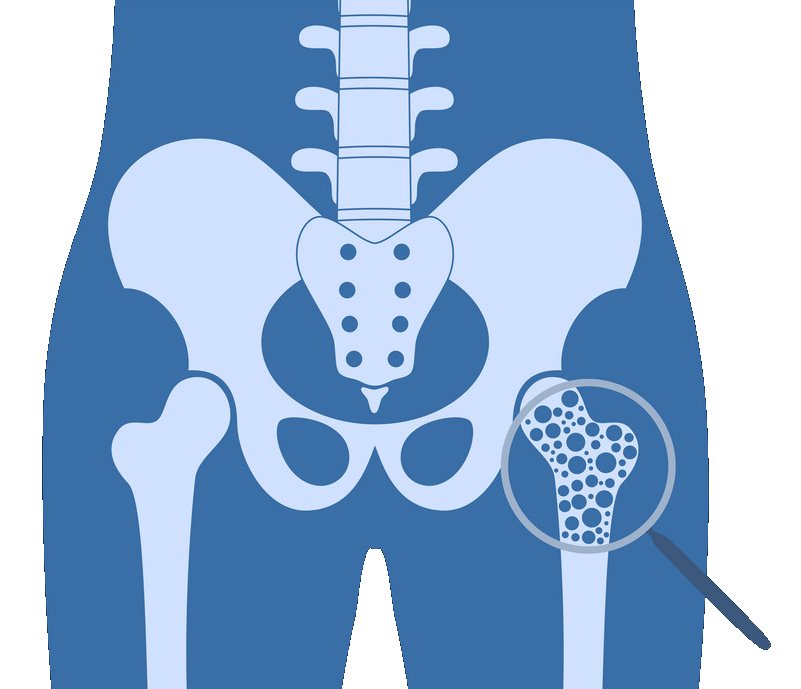 Osteoporosis | Coastal Carolinas Interventional Spine