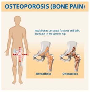 Osteoporosis in North Myrtle Beach SC 1