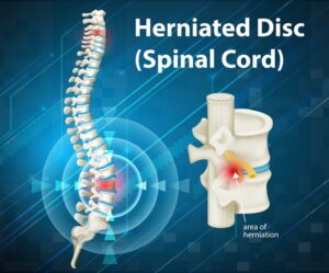 cervical herniated disc in North Myrtle Beach SC
