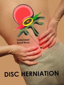 cervical herniated disc in North Myrtle Beach SC