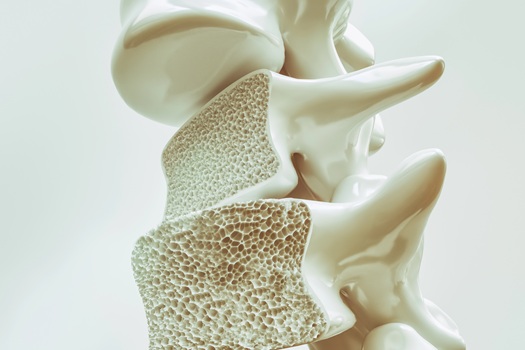 Bone density loss in North Myrtle Beach SC