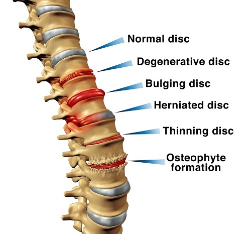 Degenerative Disc North Myrtle Beach SC